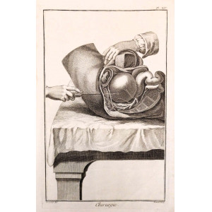 Chirurgie-Planche XIV. Parigi, 1751-1772. 